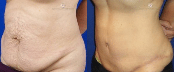 BodyTite vs. Tummy Tuck: Which Procedure is Best?